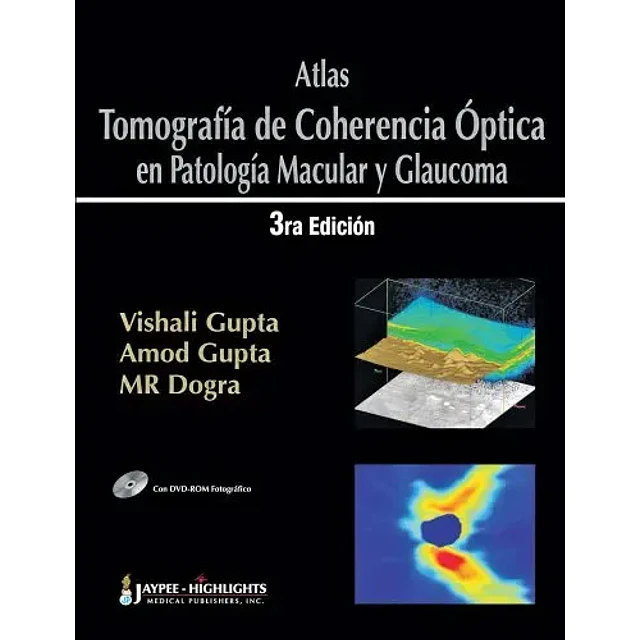 Atlas Tomografía de Coherencia Óptica en Aptología Macular y Glaucoma