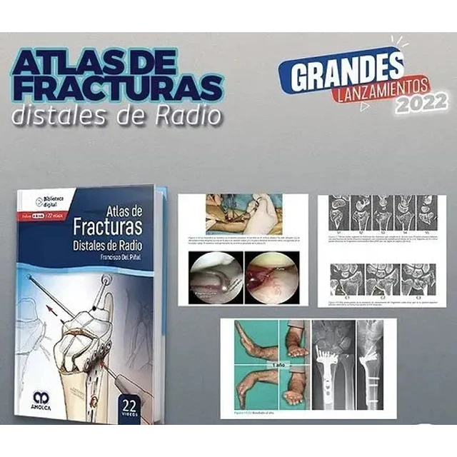 Atlas de Fracturas Distales de Radio