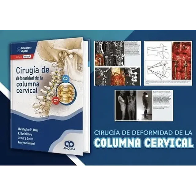 Cirugía de deformidad de la Columna Cervical