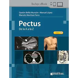 Pectus de la A a la Z