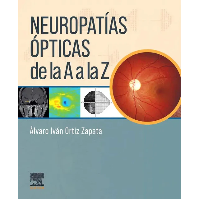 Neuropatías ópticas de la A a la Z