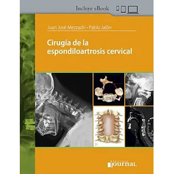 Cirugía de la Espondiloartrosis Cervical
