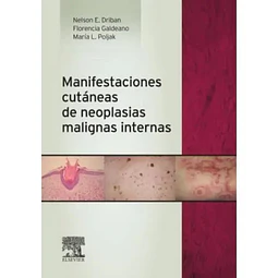 Manifestaciones cutáneas de neoplasias malignas internas