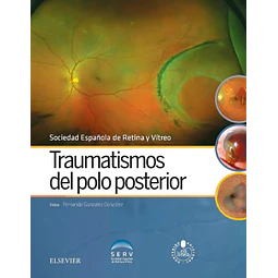 Traumatismos del polo posterior. Contenido adicional en línea