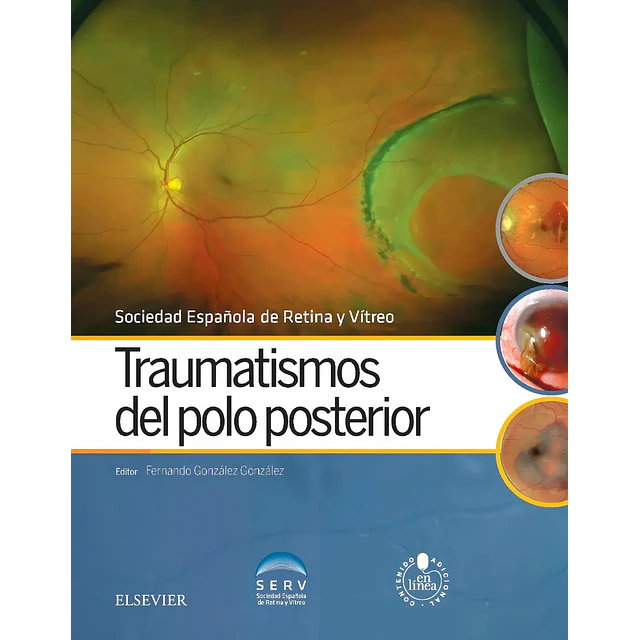 Traumatismos del polo posterior. Contenido adicional en línea