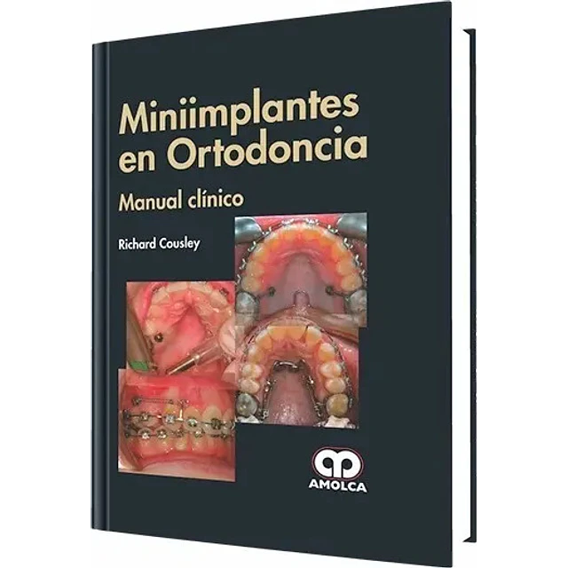 Miniimplantes en Ortodoncia