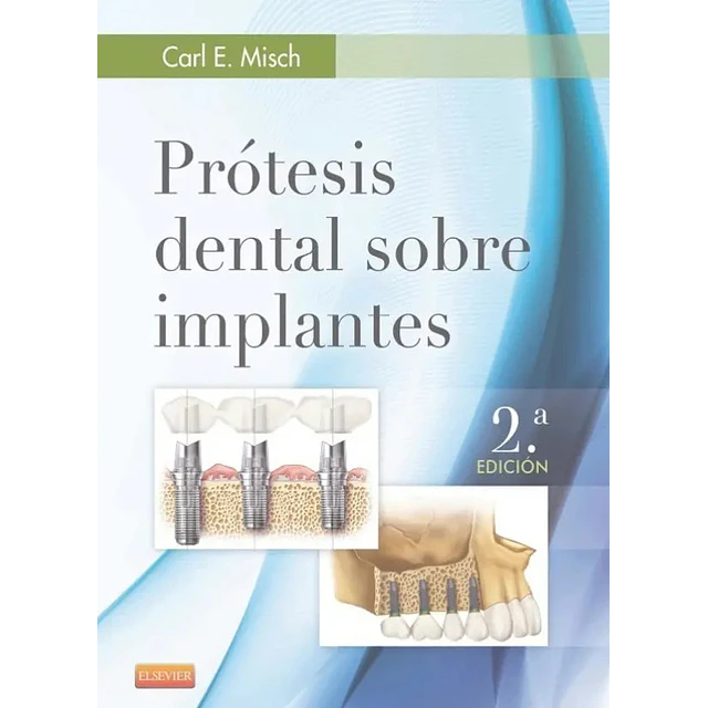 Prótesis dental sobre implantes