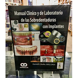 Manual Clínico y de Laboratorio de las Sobredentaduras con Implantes