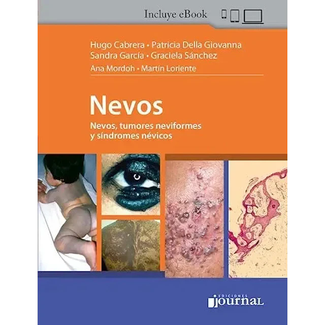 Nevos. Nevos, tumores neviformes y síndromes névicos