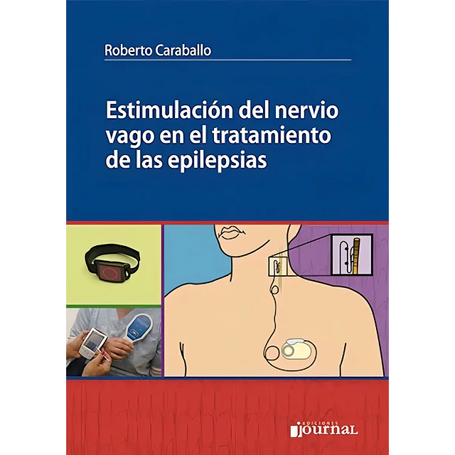 Estimulación del nervio vago en el tratamiento de las epilepsias