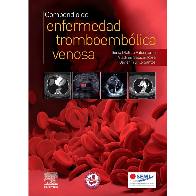 Compendio de enfermedad tromboembólica venosa