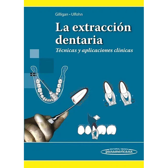 La Extracción Dentaria