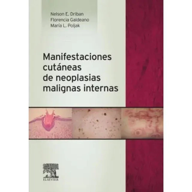 Manifestaciones cutáneas de neoplasias malignas internas