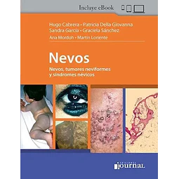 Nevos. Nevos, tumores neviformes y síndromes névicos