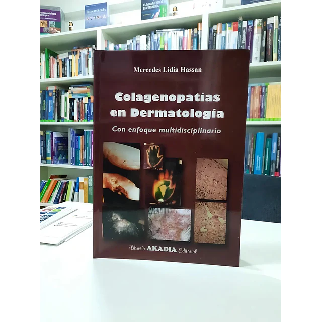 Colagenopatías en Dermatología