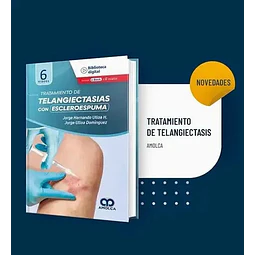 Tratamiento de telangiectasias con escleroespuma
