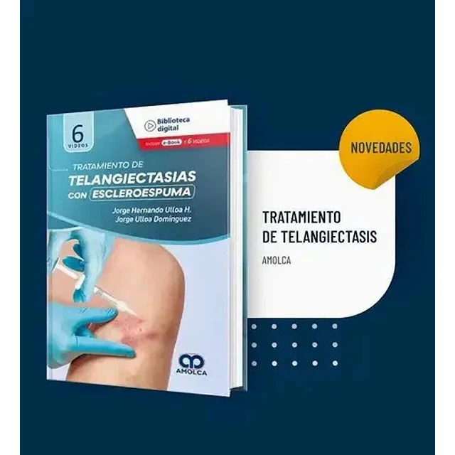 Tratamiento de telangiectasias con escleroespuma