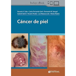 Cáncer de Piel