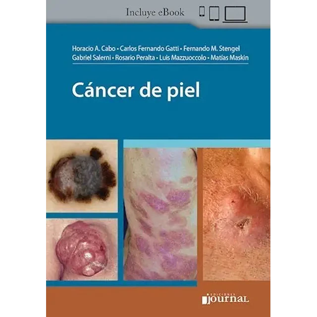 Cáncer de Piel