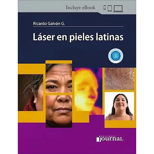Láser en pieles latinas