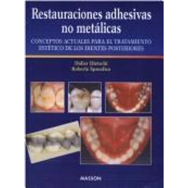 Restauraciones adhesivas no metalicas
