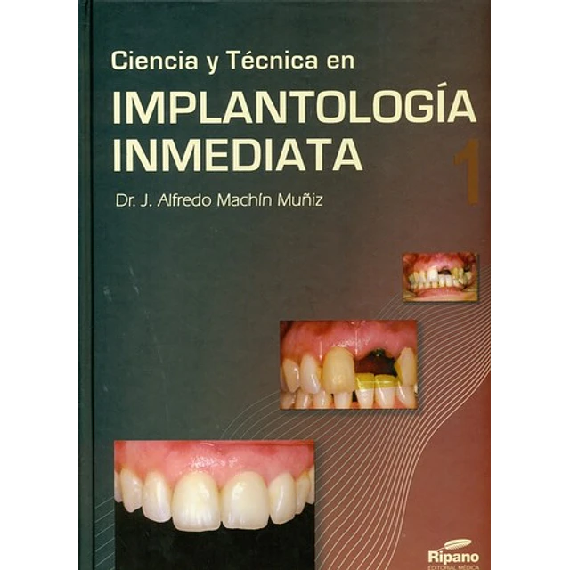 Ciencia y Tecnica en Implantologia Inmediata - 2 Tomos