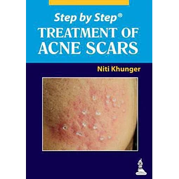 Treatment of Acne Scars