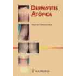 Dermatitis atopica