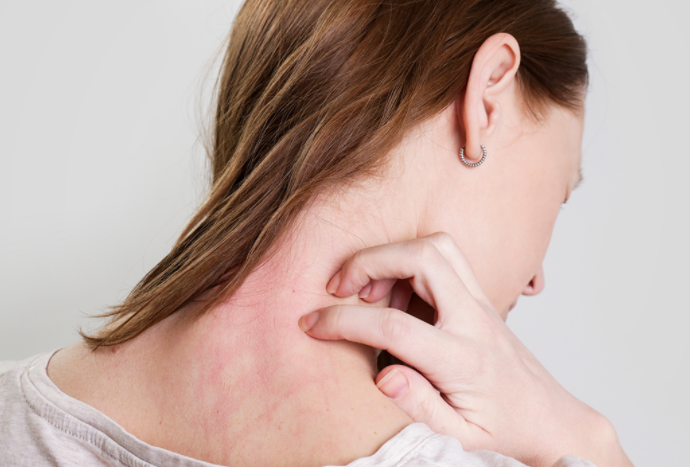 El eczema y consejos prácticos para combatirlos. 
