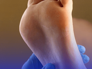 Actualizaciones en el Manejo del paciente con pie diabético / 30 Hrs