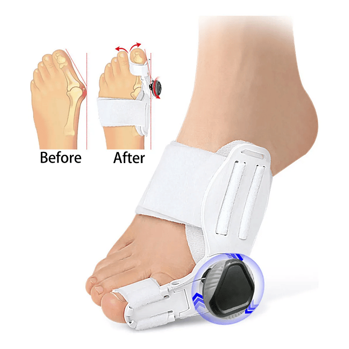 Corrector de Juanete Reegulable - FeetiFix 1