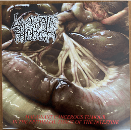 Lymphatic Phlegm / Flesh Grinder – Malignant Cancerous Tumour In The Epithelial Tissue Of The Intestine / From Rotten Process... To Anatomy LP