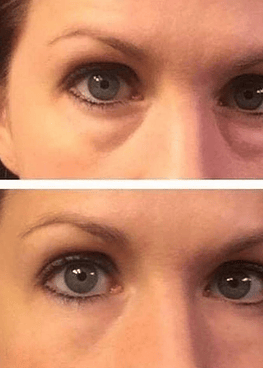 KIT DUO Antiojeras✨