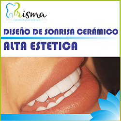 DISEÑO DE SONRISA CERÁMICO ALTA ESTÉTICA