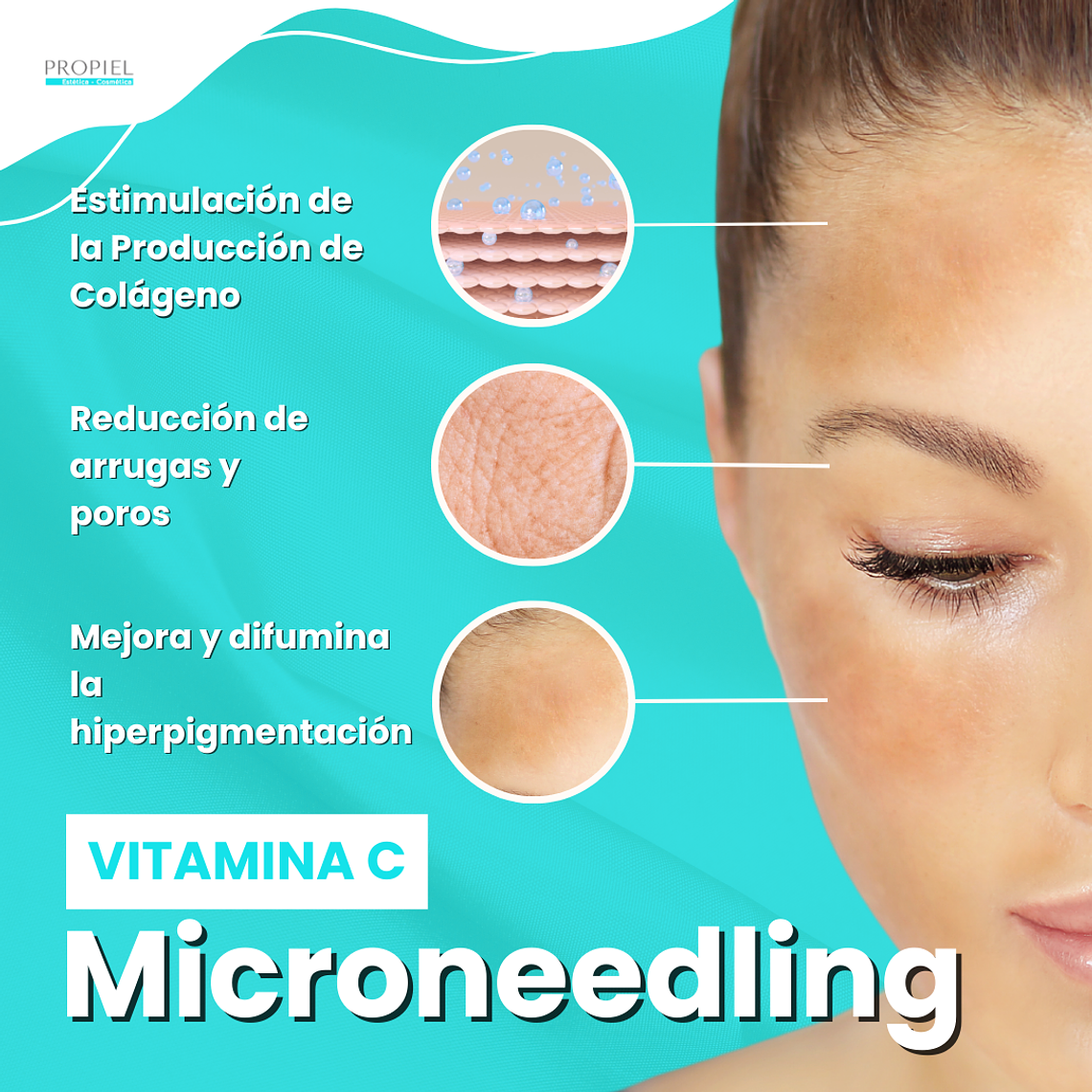 Limpieza Facial + Microneedling + Vitamina C 2