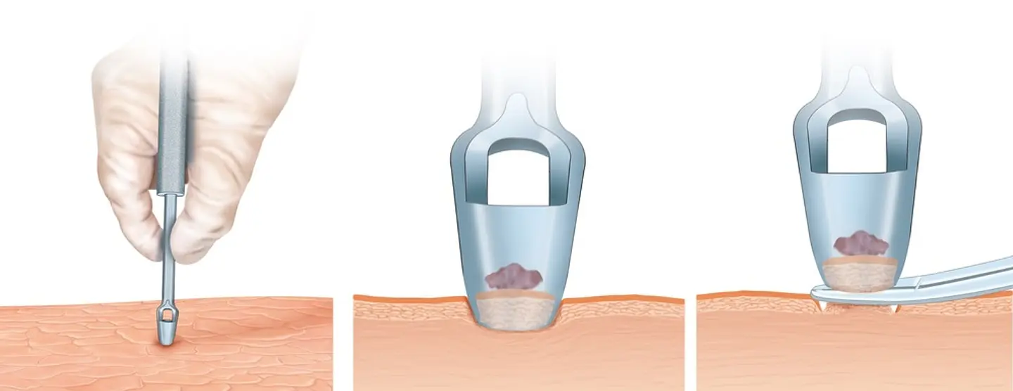 PUNCH O PUNZÓN DE BIOPSIA DE PIEL KEYES 4