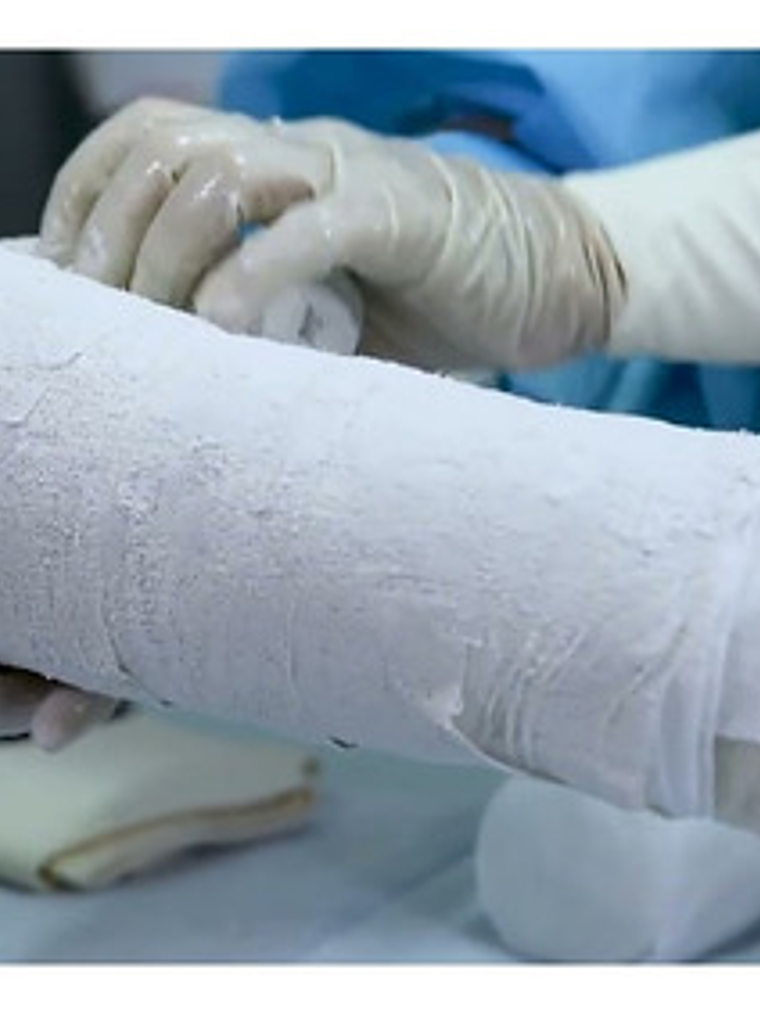 Venda De Yeso 5cmx 3m Yesoterapia Lesiones Moldes - 1 Unid 2