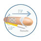 Extensor Peniano Androextender Andromedical - Thumbnail 4