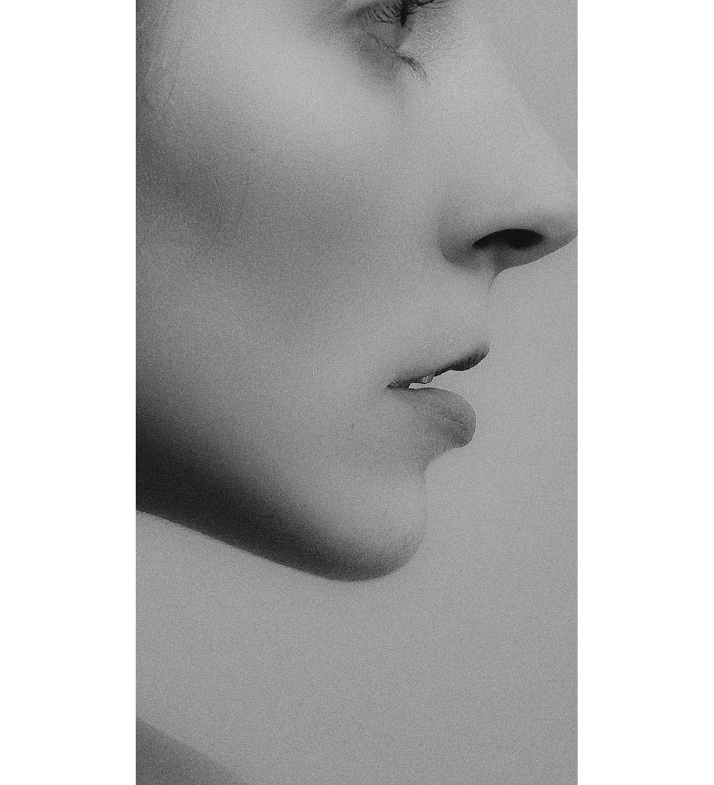 UPPER LIP LIFT + CIERRE ALAR