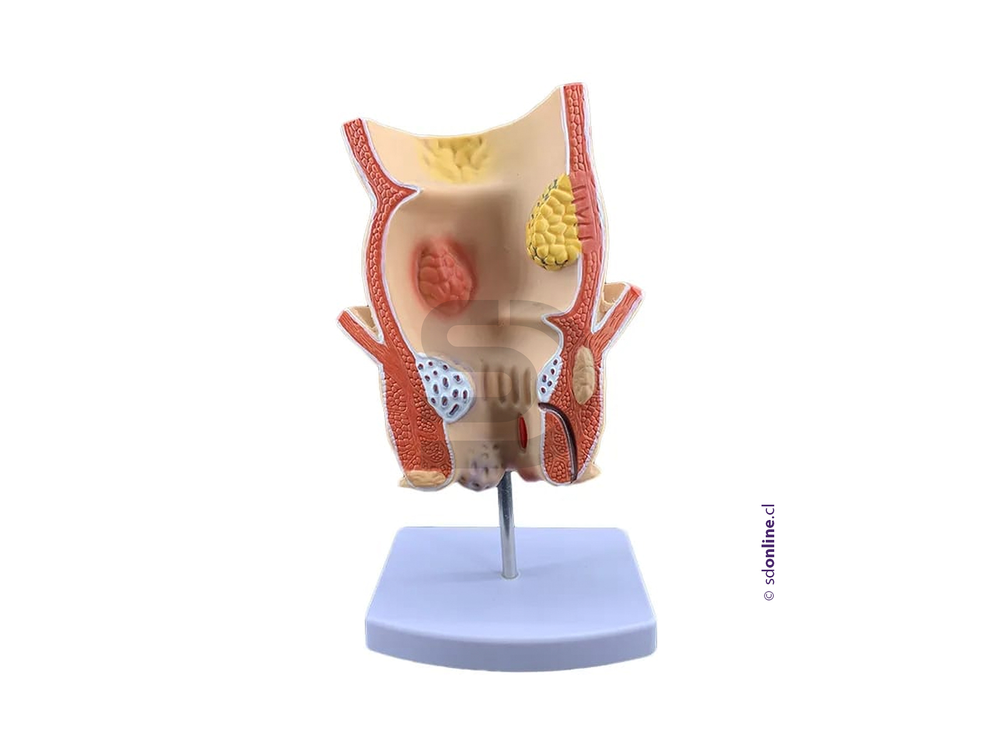 Modelo patología rectal 1