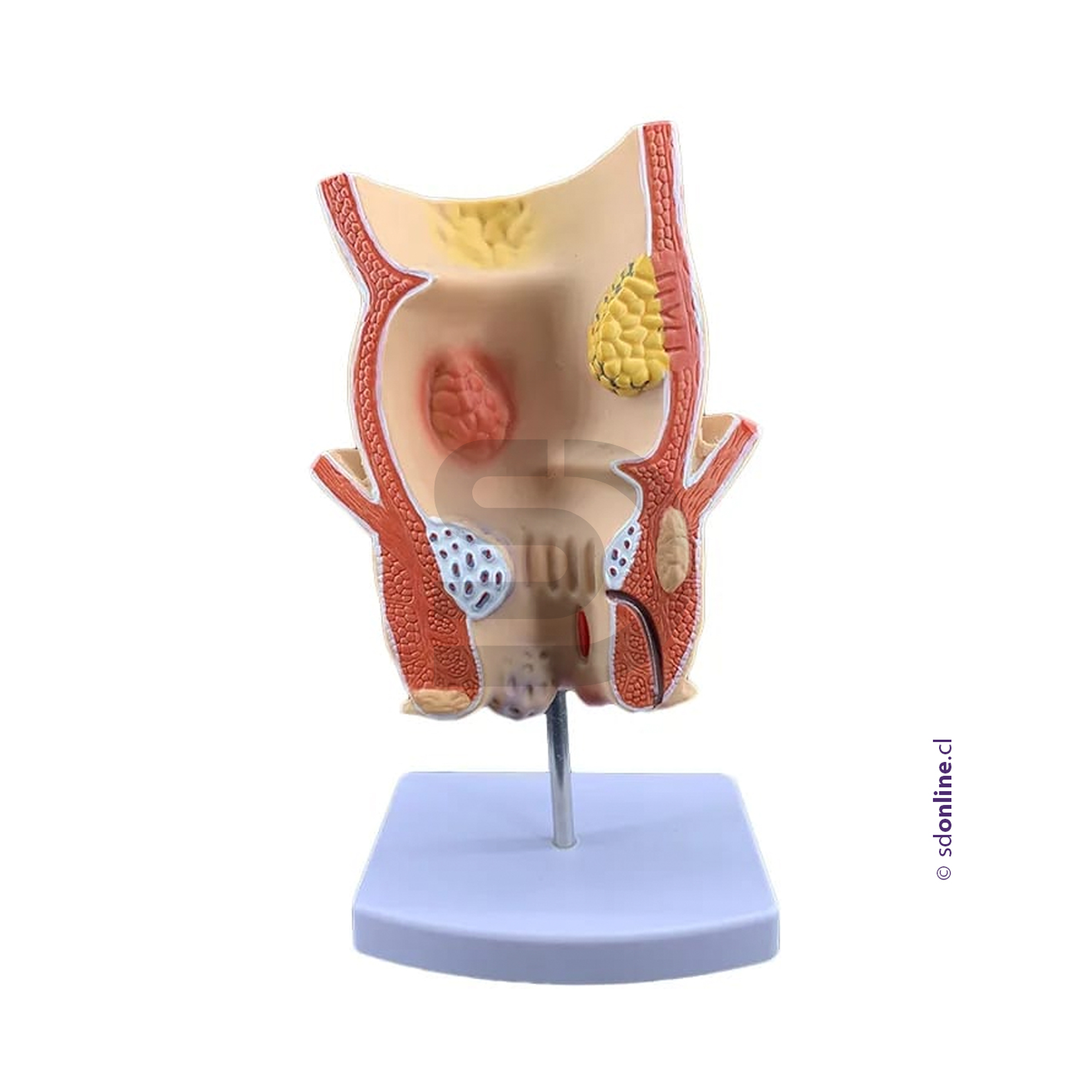 Modelo patología rectal 1