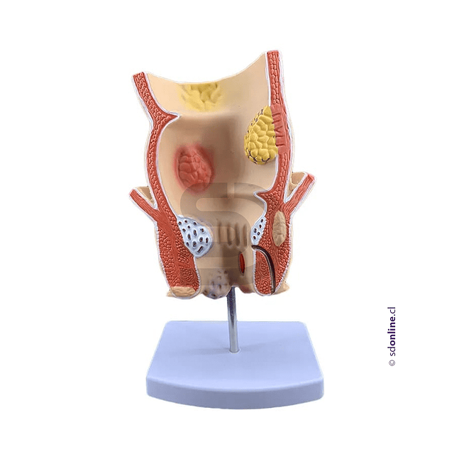 Modelo patología rectal