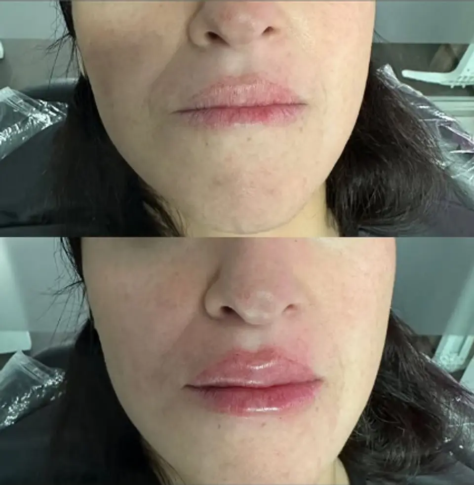 Skinboosters (Restylane) 2