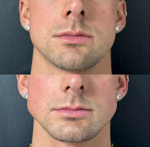 Perfilado Mandibular