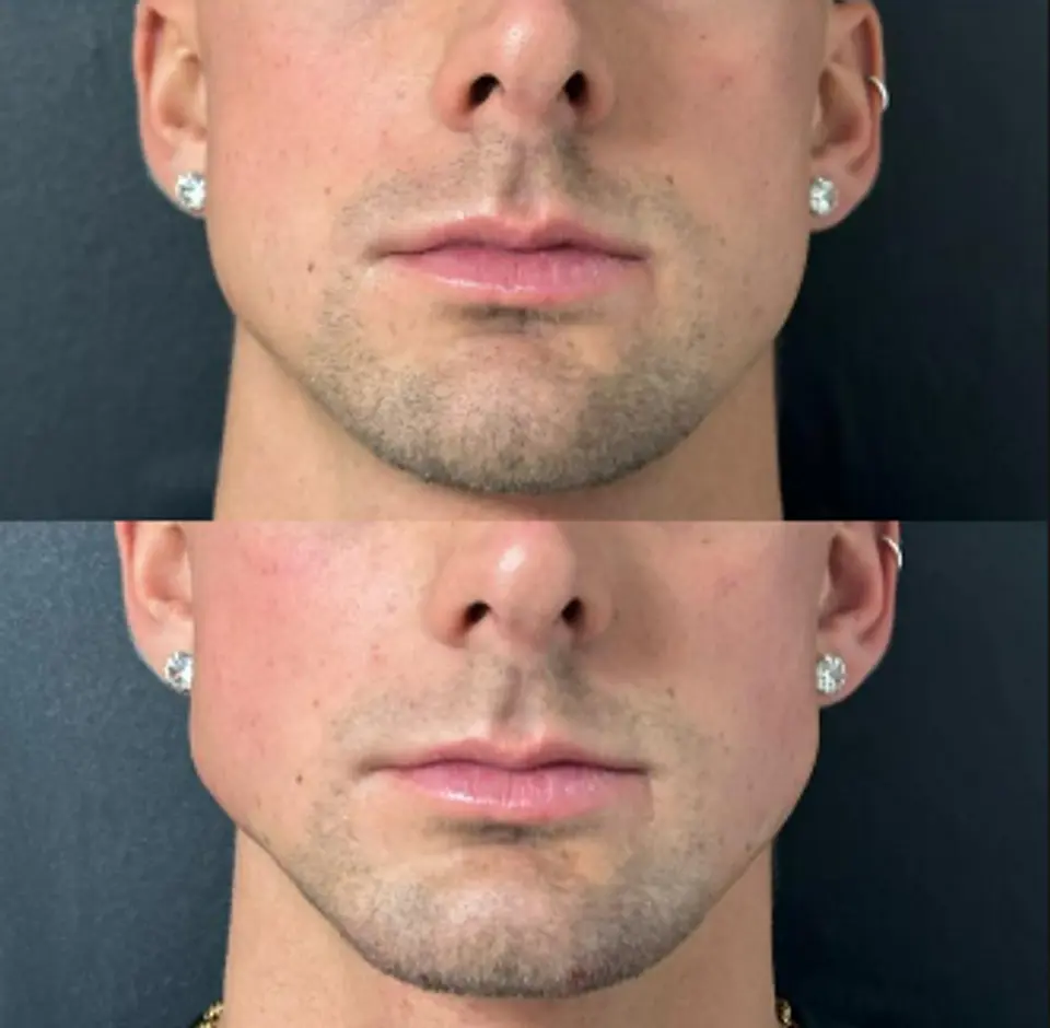 Perfilado Mandibular 1