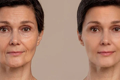 Rejuvenecimiento facial