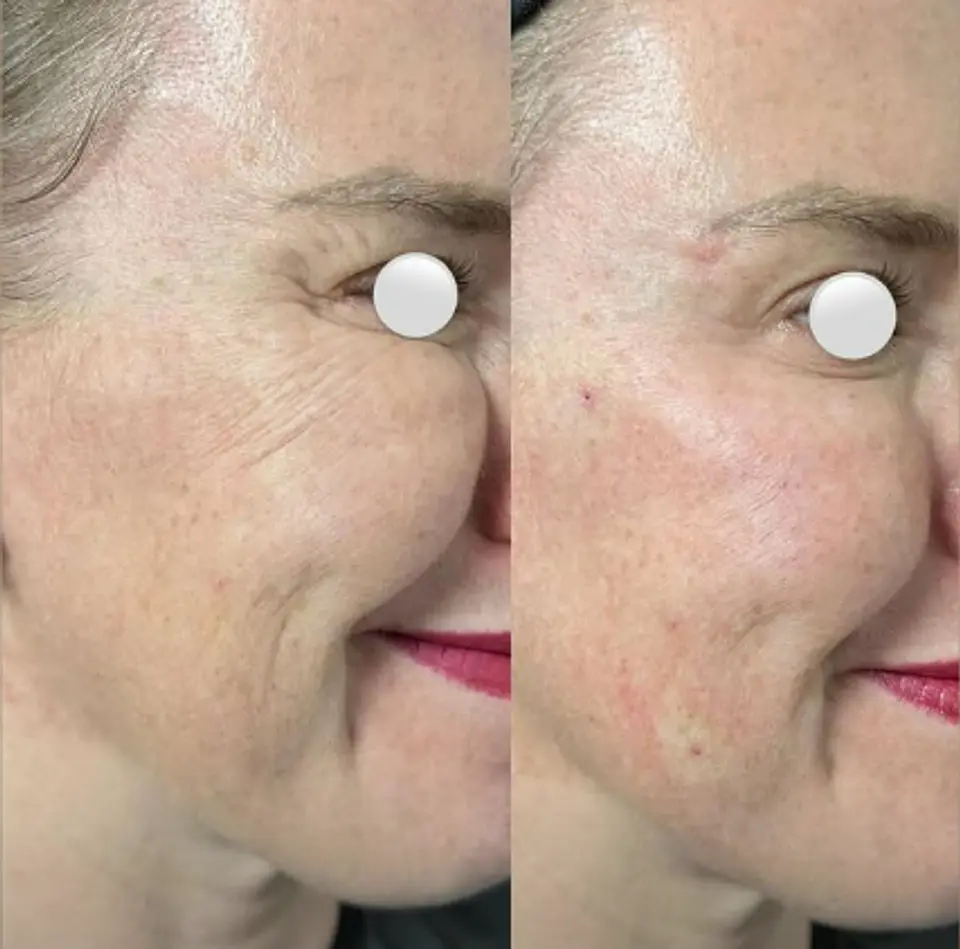 Toxina botulínica 2