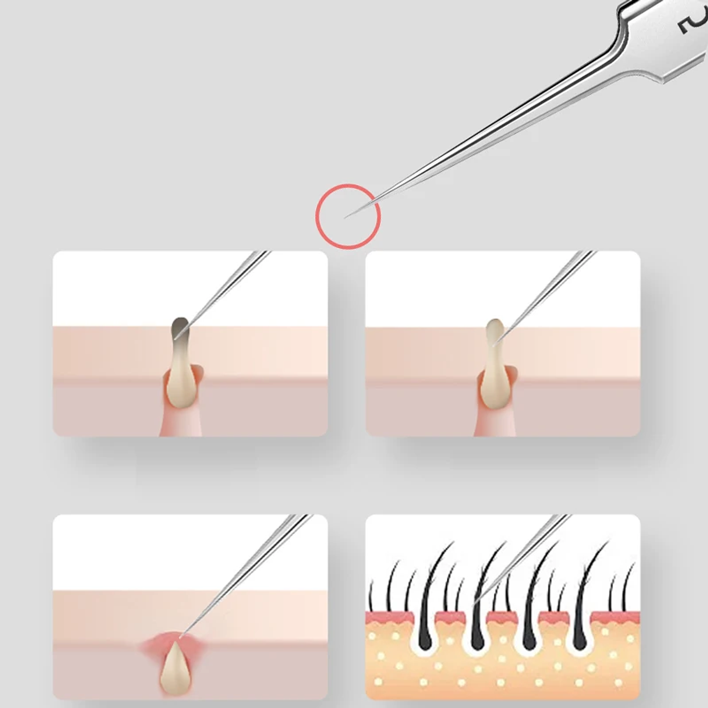 German Ultra-Fine No. 5 Cell Pimples & Blackhead Tweezers 16