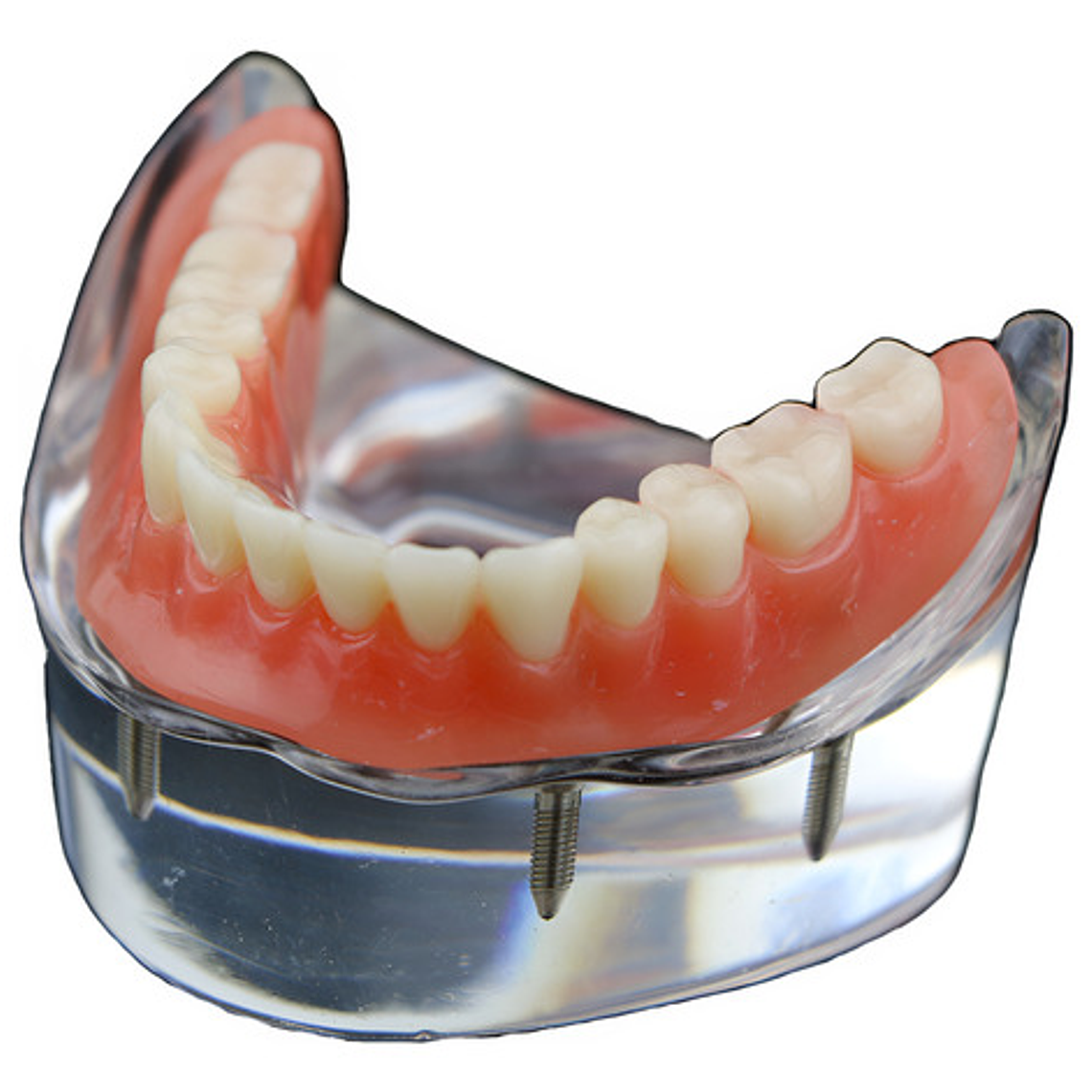 Modelo Sobre Dentadura Implantes Novedad Enseñanza Santiago 1
