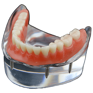 Modelo Sobre Dentadura Implantes Novedad Enseñanza Santiago
